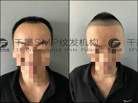 重庆纹发技术适合脱发的各个年龄阶段