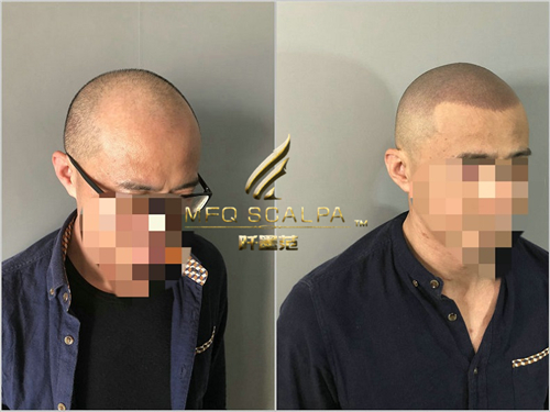 作为重庆脱发者，重庆纹发阡墨范感同身受