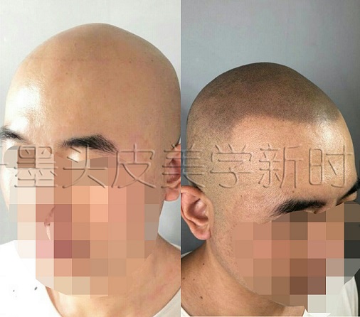 专业的纹发技术必须由专业的重庆纹发机构来做