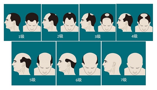 脱发不是绝症，纹发新概念你的新选择