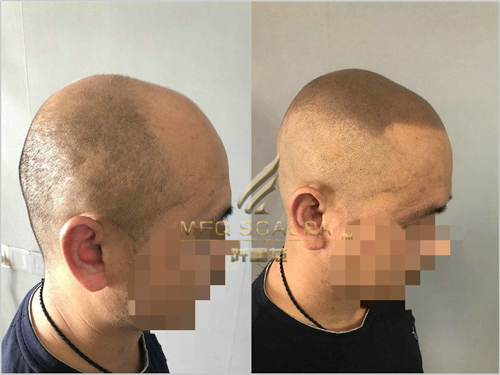脱发不是绝症，纹发新概念你的新选择