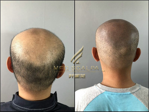 重庆纹发治愈你因为脱发的痛苦
