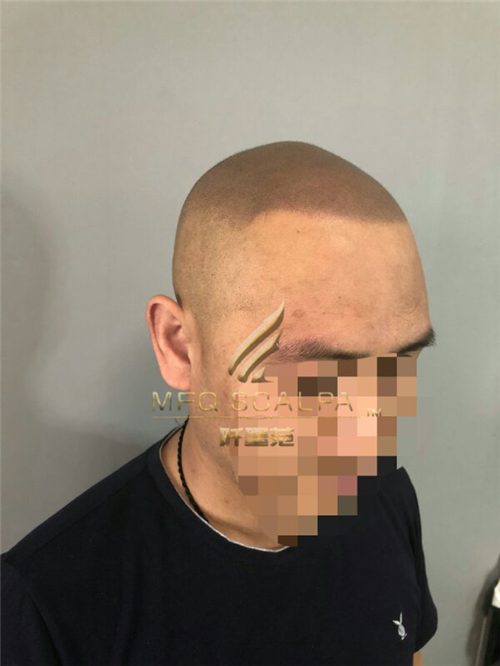 重庆纹发治愈你因为脱发的痛苦