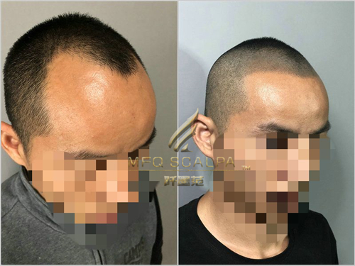 脱发调理收效胜微？纹发成最后的稻草