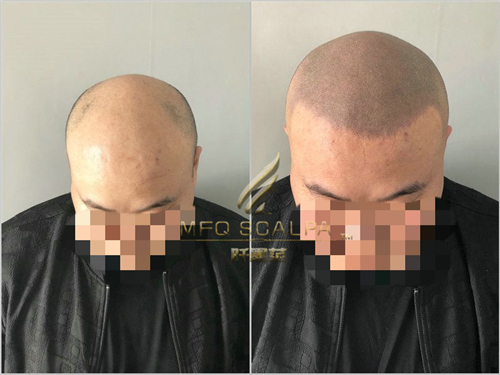 重庆纹发色点与毛囊大小接近