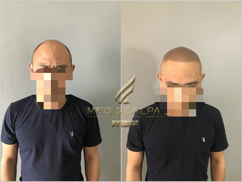 面对效果参差不齐的纹发机构，该怎么选择？