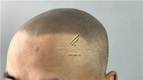 你知道重庆纹发带给你好处？跟着我一道了解