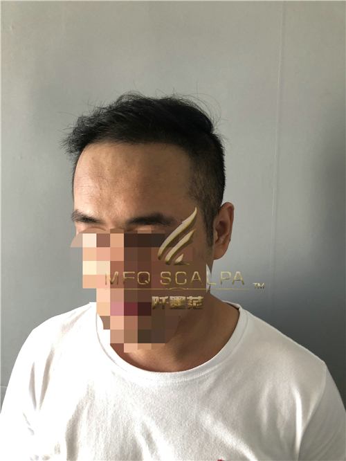 脱发的你，直接降低在别人眼中的印象