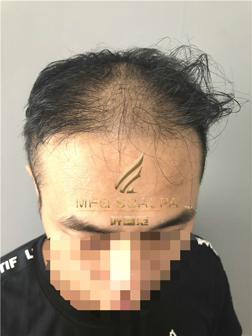 脱发的你，直接降低在别人眼中的印象
