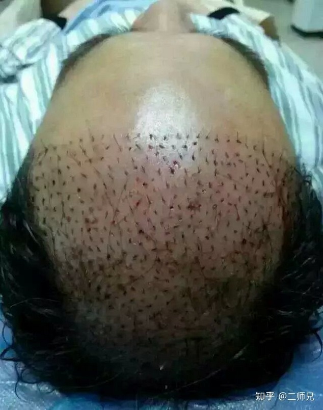 重庆纹发来救助植发的三点不足