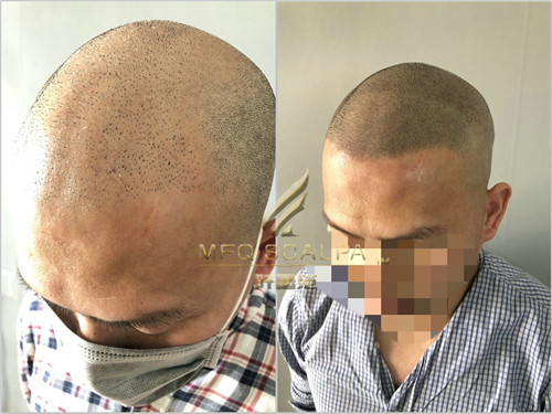 重庆纹发来救助植发的三点不足