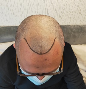 脱发的你甘愿人生就这样被定义了？