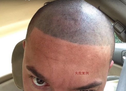纹发失败有哪些因素？表现在哪些方面？