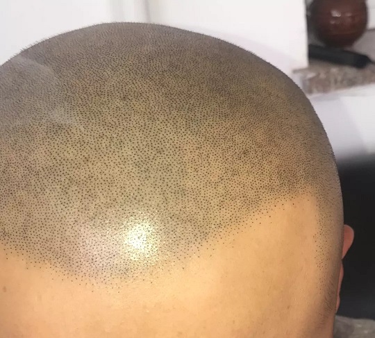 纹发失败案例分析