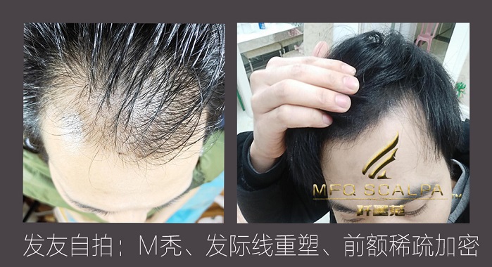 纹发的误区：纹发不是越黑越好
