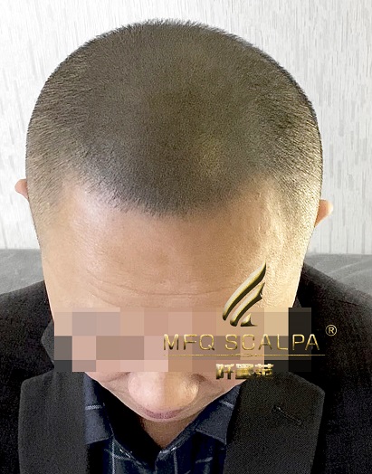脱发减龄？重庆纹发技术显年轻不是梦