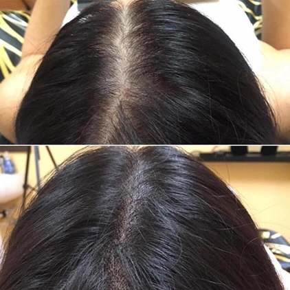 脱发的女性还在羡慕别人的人生？纹发帮助你神助攻