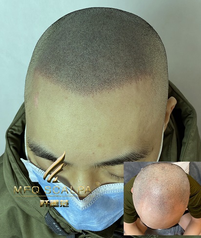 脱发的你其实还有更好的选择——纹发