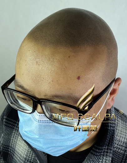 脱发的你如何挽救你的爱情？来重庆纹发吧