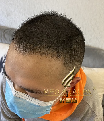 重庆纹发技术针对在秃顶和长发着色有什么区别？