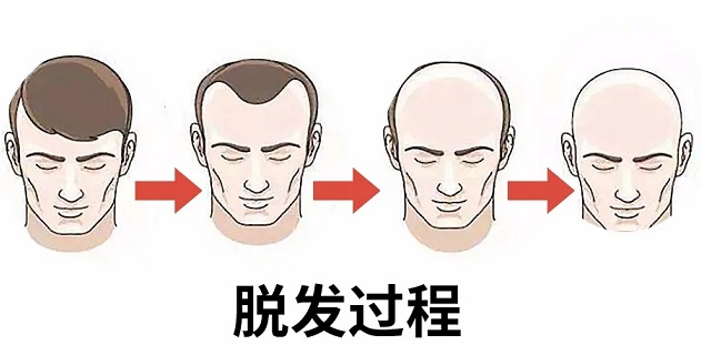 重庆纹发过程麻烦吗？秃顶是如何纹发的呢？