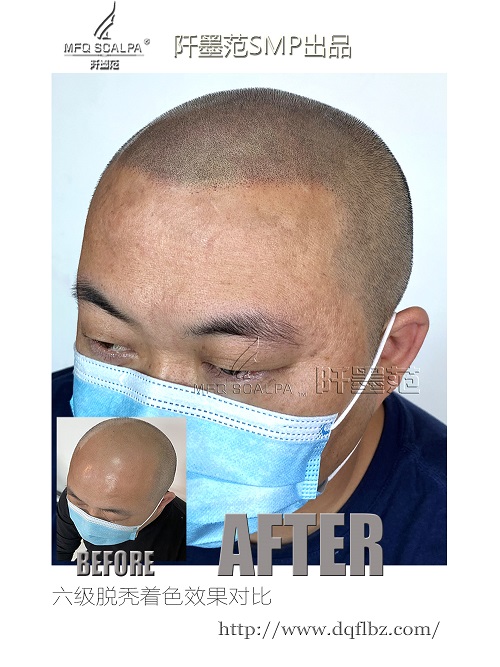 纹发后发型就是比秃头好看