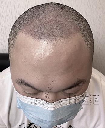 发际线高低问题，重庆纹发能解决吗？