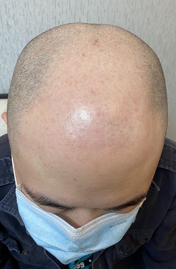 选择纹发技术迫在眉睫，让你清凉一夏