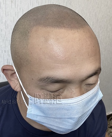 用重庆纹发改变遗传脱秃的宿命，让青春再次回归