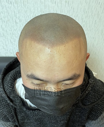 脱发秃顶多年的他也来了重庆纹发工作室