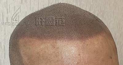 稀疏的头发再次浓密，密发的新科技—重庆纹发