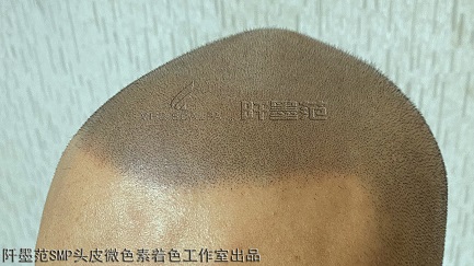 如果脱发没辙了也别灰心，有种新技术叫重庆纹发