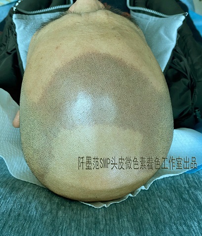 纹发是花钱不多，能根本上解决脱发烦恼的方法。