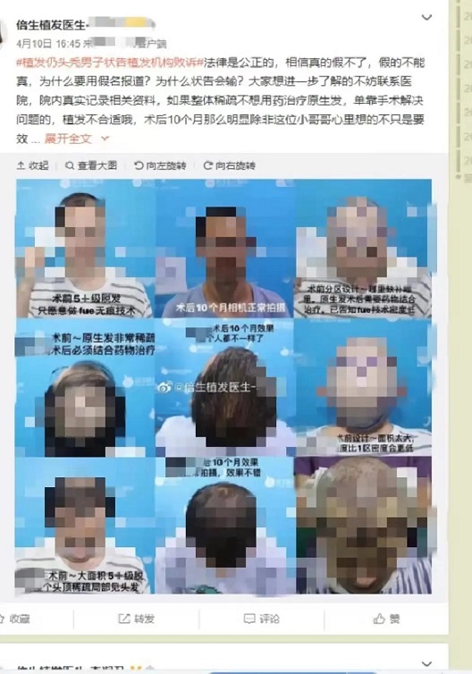 植发花了两万元，头顶还是光秃秃的，谁的错？