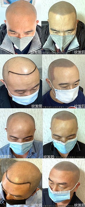纹发和植发能够同时采用吗？孰先孰后？