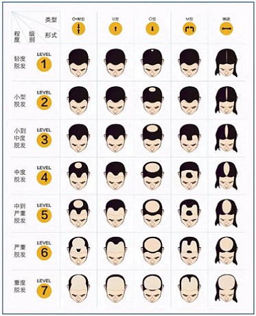 对于不可逆的雄性激素脱发，可以通过重庆纹发改善形象。