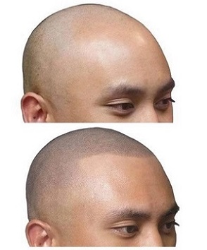 重庆纹发会使我的头发长回来吗？为什么纹发一周后效果不是很明显？