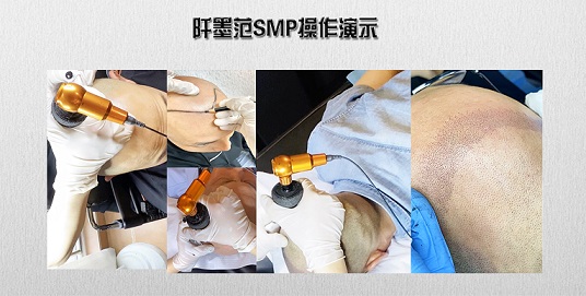 重庆纹发阡墨范将根据您的脱发情况，并确定最佳的着色方案