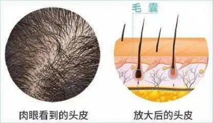 脱发通常是由于毛囊受到外界刺激而损伤甚至死亡