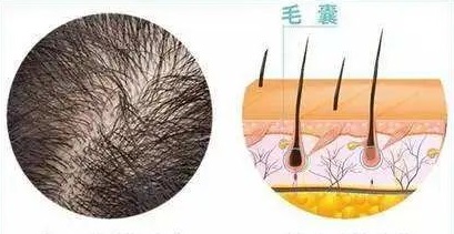 脱发只代表负面意义吗？