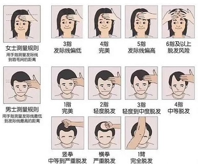 脱发很多年，你走了多少治脱的弯路？