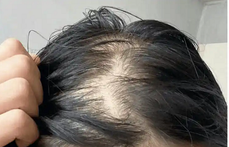 脂溢性脱发病因机制复杂，有没有最常见的联合用药方案？