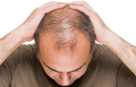 脱发常被与 “衰老”“不健康”“能力不足” 关联