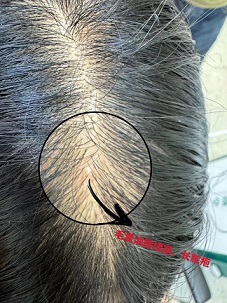 头皮常见的皮肤病及其特点、成因