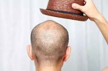 男性脱发为什么通常传男不传女？