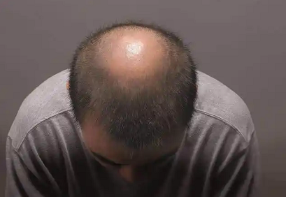 脱发后的心理变化通常是怎样的？