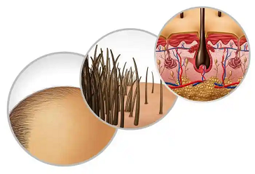 是谁在破坏头发，谁是毛囊杀手？