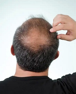 脱发对身体健康有没有影响？