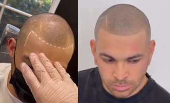 最实用、最高级的重庆纹发发际线设计方法 最实用、最高级的重庆纹发发际线设计方法